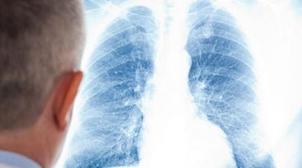 La pneumonie a coûté la vie à plus de 800.000 enfants en 2018