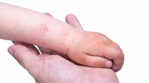 9e Journée de l’auto-immunité: "Ammais" s’intéresse aux allergies et aux maladi…