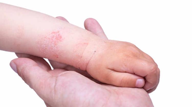 9e Journée de l’auto-immunité: "Ammais" s’intéresse aux allergies et aux maladi…