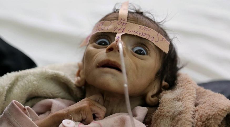 Yémen : 75% des enfants souffrent de malnutrition chronique (OMS)