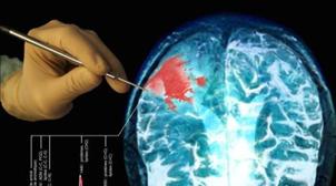 Phase terminale de cancer : Un nouveau traitement capable de détruire les tumeu…