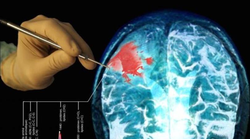 Phase terminale de cancer : Un nouveau traitement capable de détruire les tumeu…