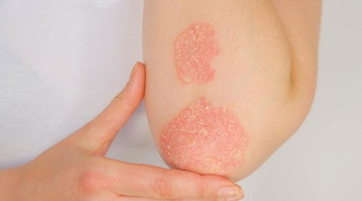 Sabahiyate: Le psoriasis, une maladie affligeante influencée par le moral