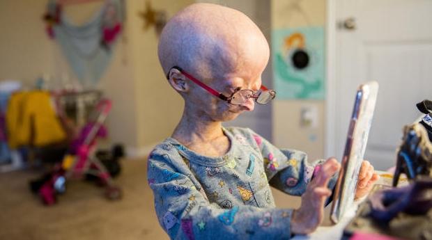 Journée mondiale des maladies rares : un dépistage néonatal permettrait d’évite…